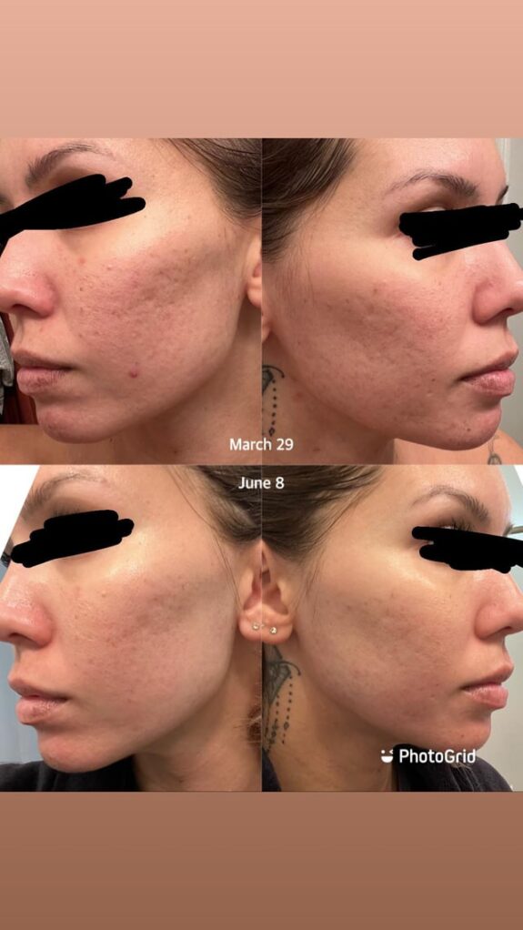 Azelaic Acid, Clindamycin, & Tretinoin topical treatment.