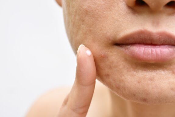 Azelaic acid serum for skin brightening.