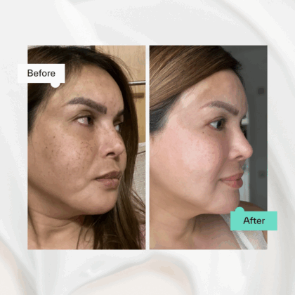 Azelaic Acid 15% before & after: improved skin clarity.