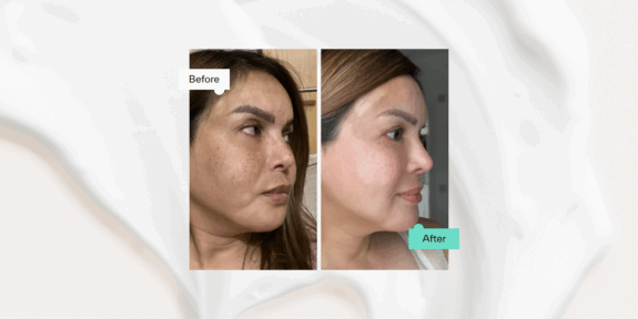 Azelaic Acid Gel 15% before & after results.