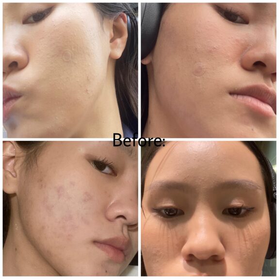 Azelaic acid treatment for oily skin.