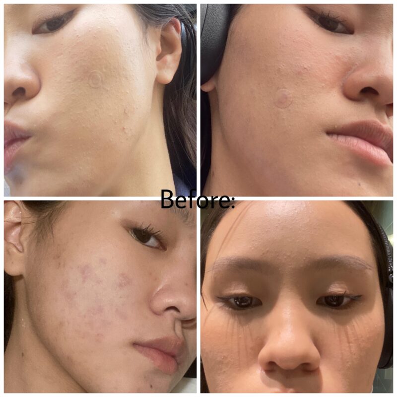 Azelaic acid cream for dry skin.