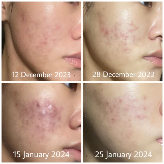 Azelaic acid treatment applied to a pimple.