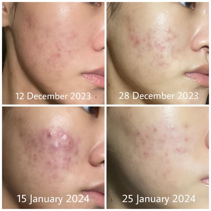 Azelaic acid treatment applied to a pimple.