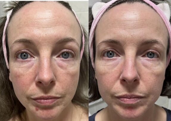 Azelaic acid eye cream.