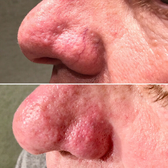 Azelaic Acid serum for broken capillaries.