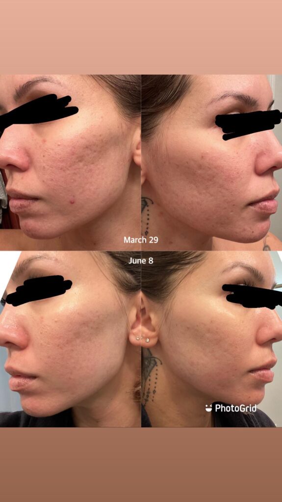 Tretinoin, azelaic acid, & clindamycin topical treatment.