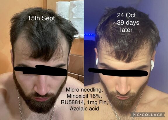 Azelaic acid hair loss treatment product.