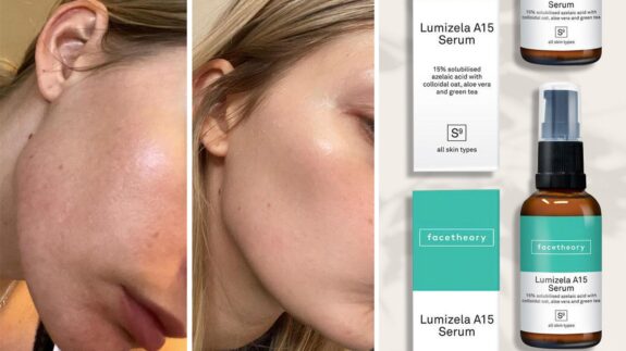 Lumizela Azelaic Acid Serum A15: Before & After results.