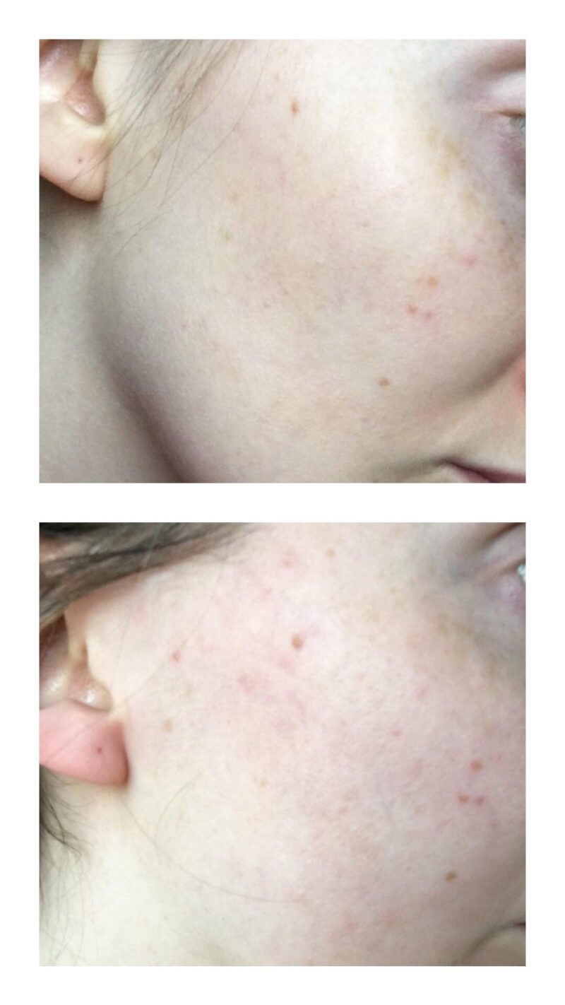 Azelaic Acid & Rosehip Oil serum bottle