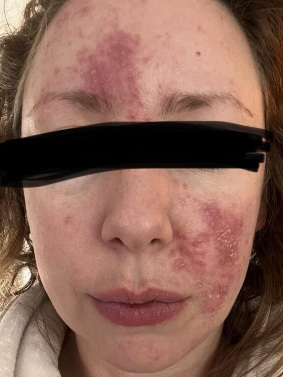 Azelaic acid serum for rosacea treatment.