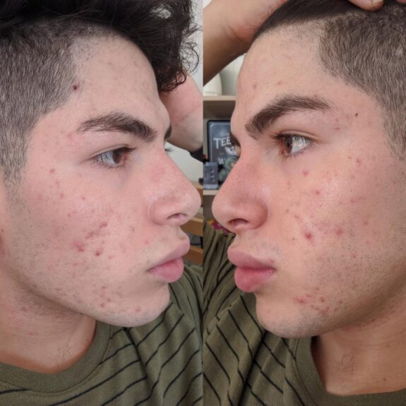 Azelaic Acid face pie, skincare treatment.