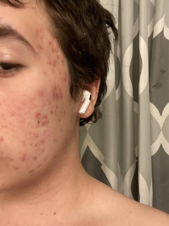 Azelaic Acid serum for post-inflammatory erythema.