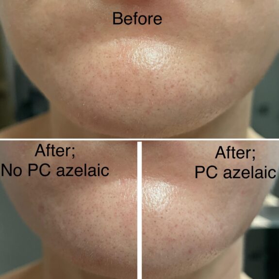 10% Azelaic Acid Booster serum bottle.