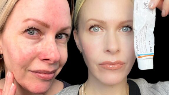 Finacea Azelaic Acid: Before & After treatment results.