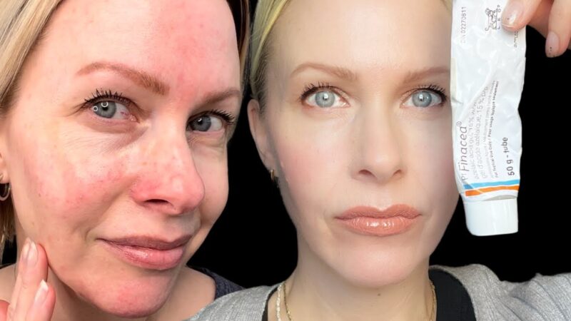 Finacea Azelaic Acid: Before & After treatment results.