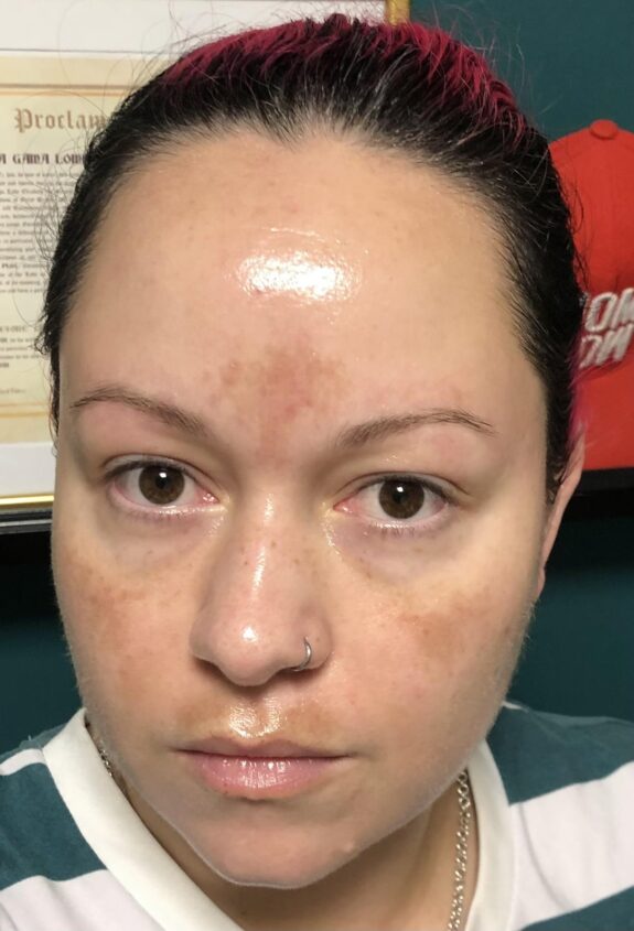 Azelaic acid serum for hyperpigmentation treatment.