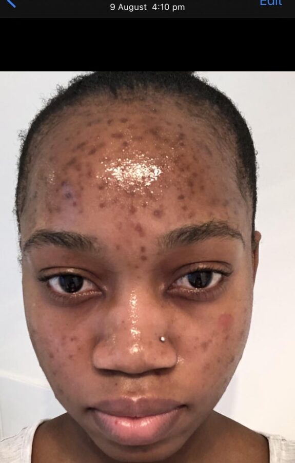 Azelaic acid & hydroquinone serum.