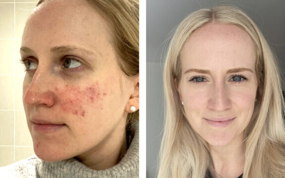 Azelaic acid treatment for papulopustular rosacea.