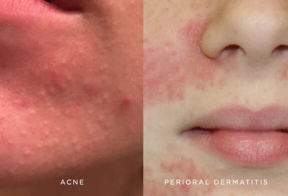 Azelaic Acid cream for perioral dermatitis treatment.