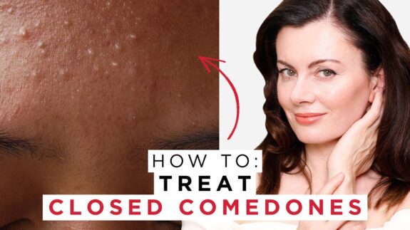 Azelaic acid treatment for closed comedones.