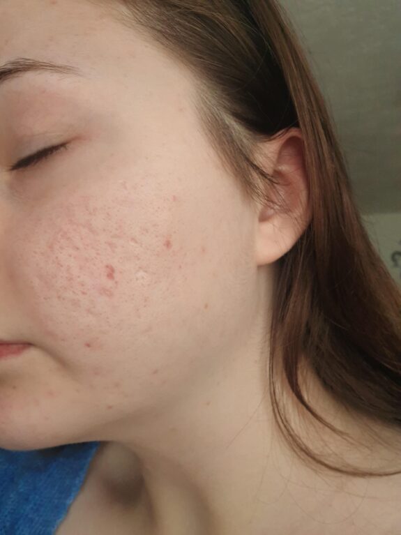 Azelaic acid & vitamin C serum bottle.