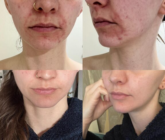 Azelaic acid cream for perioral dermatitis treatment.
