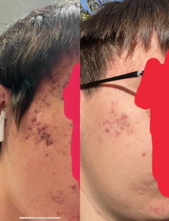 Alpha Arbutin & Azelaic Acid serum bottle.