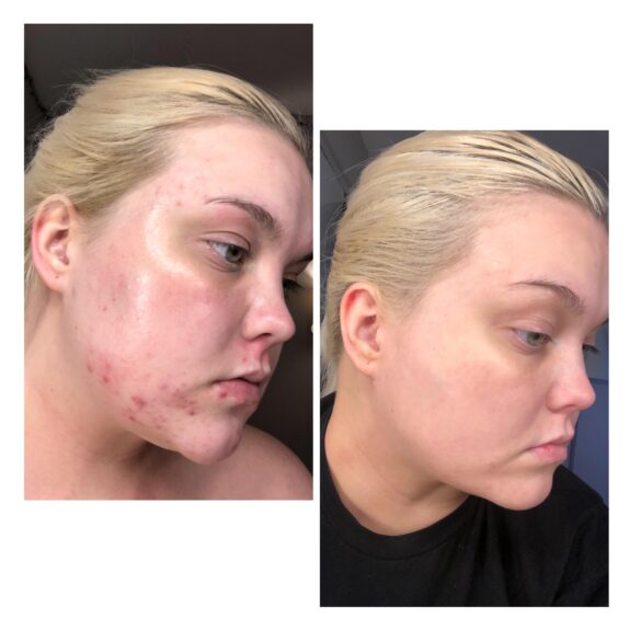 Azelaic acid and clindamycin topical treatment.