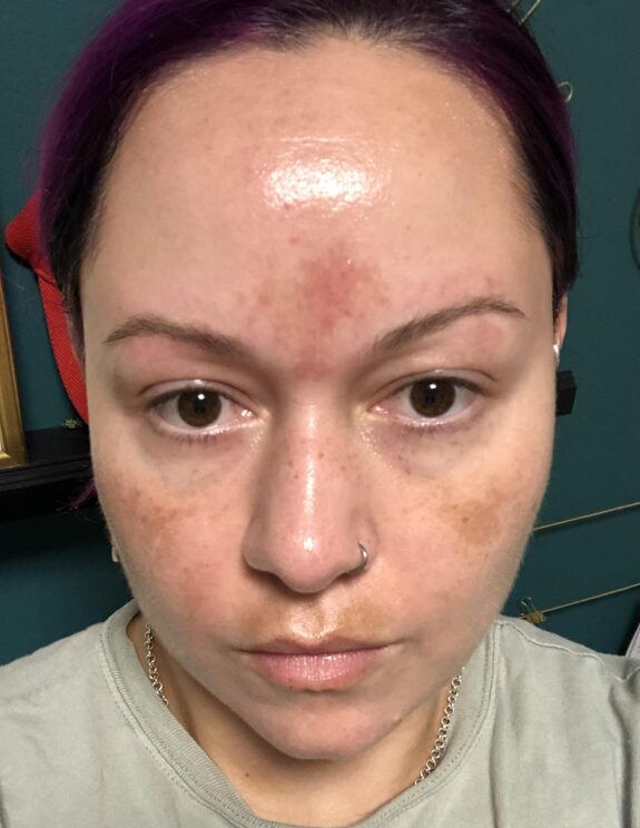 Azelaic Acid Peeling product.