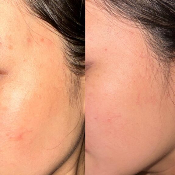 15% Azelaic Acid serum bottle