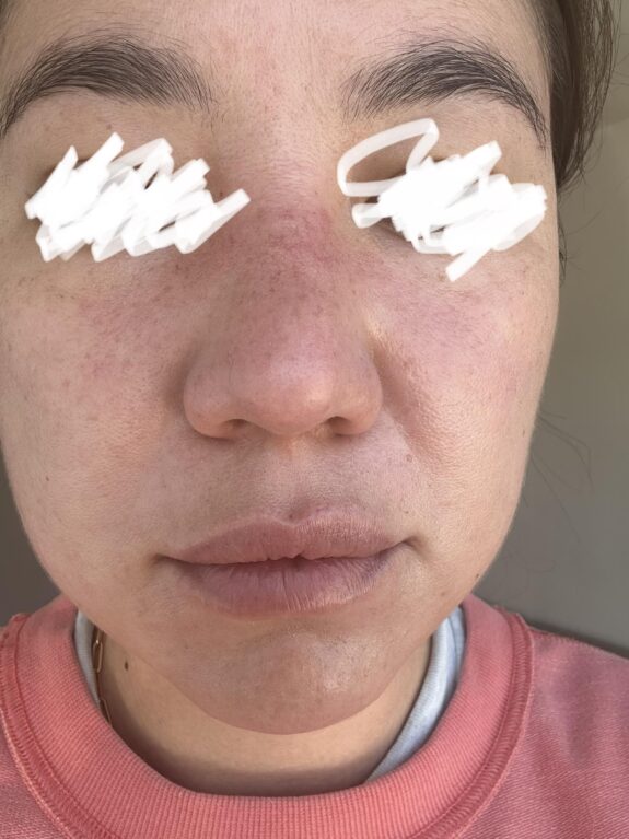 Azelaic acid serum for broken capillaries.