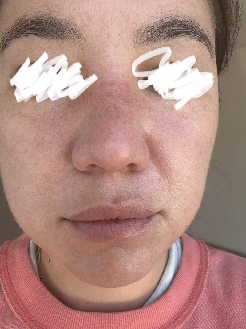 Azelaic acid serum for broken capillaries.