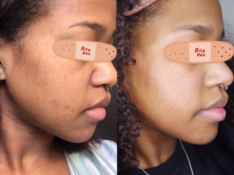 Azelaic Acid serum, skincare product.