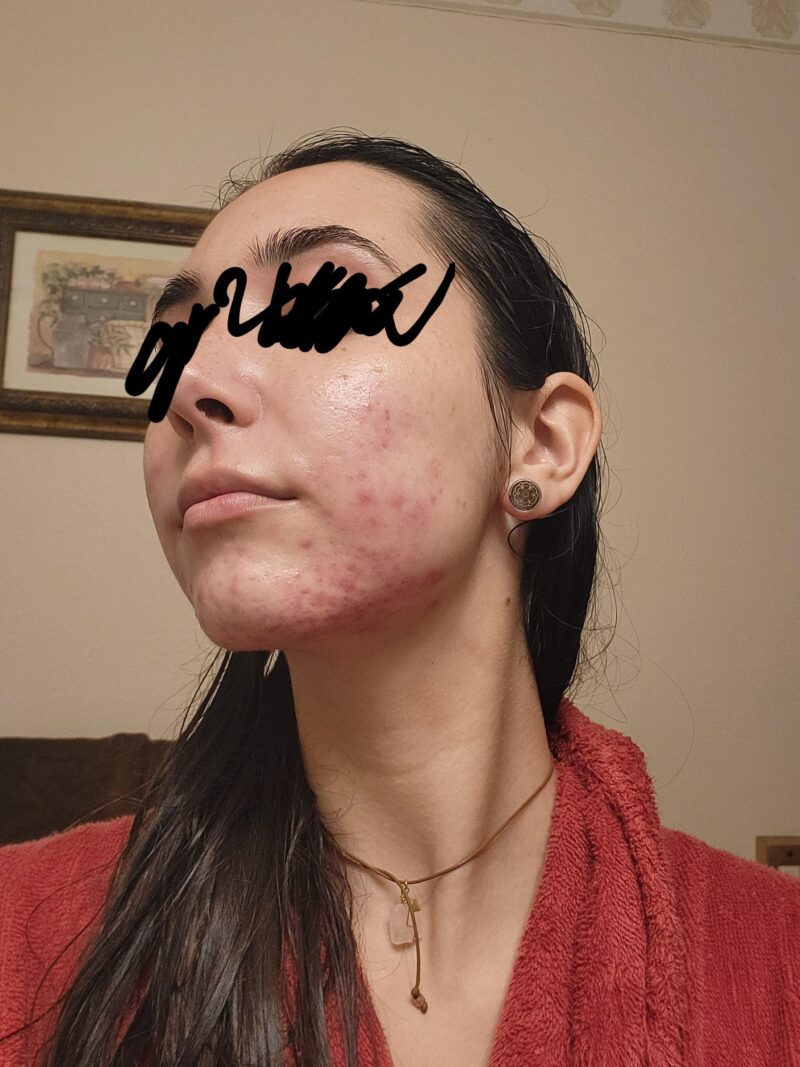 Azelaic acid and tretinoin cream.