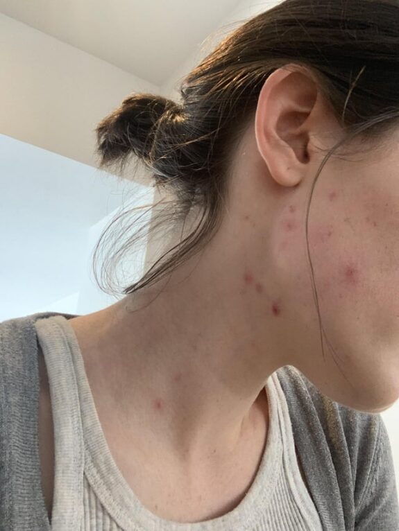Azelaic acid serum applied to neck.